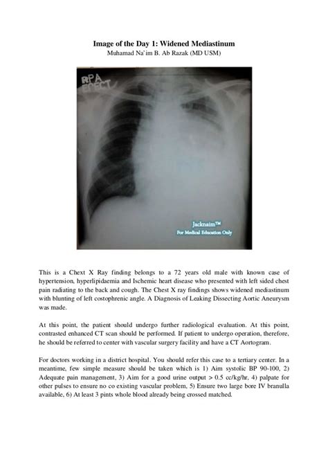 1widened Mediastinum