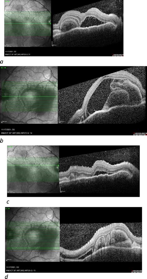 Macular OCT before treatment revealed severe serous retinal detachment ...