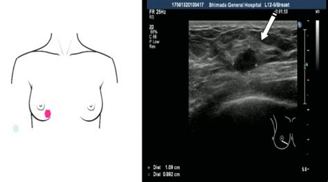 乳房超音波検査（エコー検査）について｜乳房検査（乳がん検査）｜診療案内｜医療法人積仁会 島田総合病院