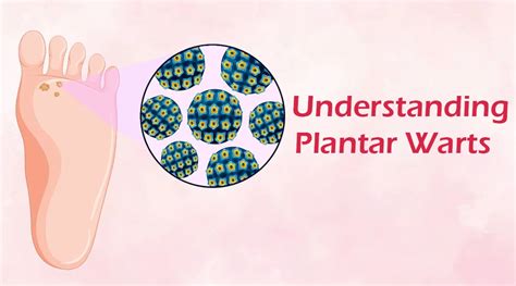 Understanding Plantar Warts | Sujata Birla Hospital