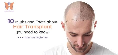 10 Myths And Facts About Hair Transplant You Need To Know