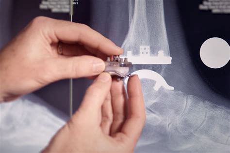 Ankle Replacement Surgery And Technology Exactech