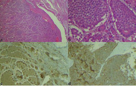 Small Intestinal Tumor In A Low Power View B High Power View C