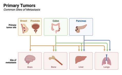 Primary Tumors and their Common Sites of Metastasis | BioRender Science ...