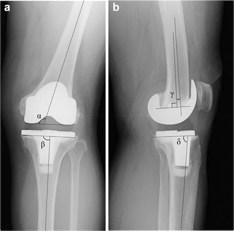 Anteroposterior A And Lateral B Plain Radiographs Before The