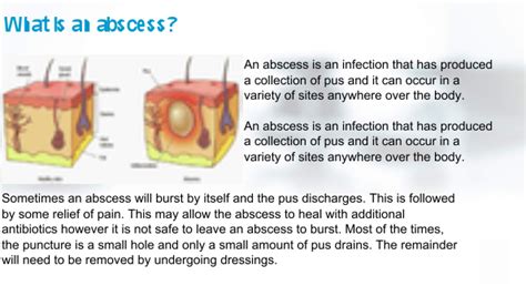 Anal Abscess Surgery Treatment in Dubai: Abscess Specialist Cosmocare ...