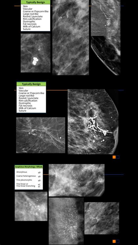 Renal ultrasound made easy step by step guide – Artofit