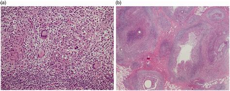 Severe Idiopathic Granulomatous Mastitis Treated With Systemic