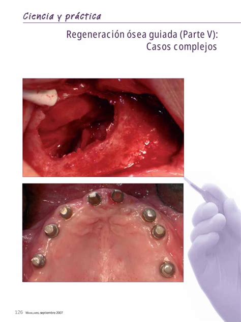 PDF Ciencia y práctica Maxillaris Regeneración ósea guiada para