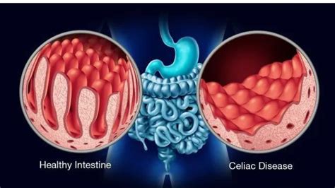 What Is The Difference Between Celiac Disease A Gluten Allergy And Gluten Intolerance