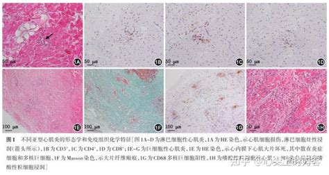 心肌炎与炎症性心肌病：深入认识病理机制 不断提升诊治水平 知乎