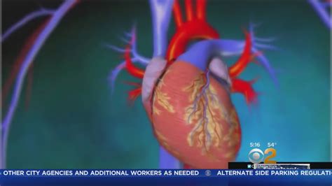 A Look At Aortic Valve Replacement Surgery Youtube