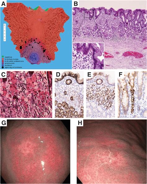 Hereditary Diffuse Gastric Cancer Gastroenterology