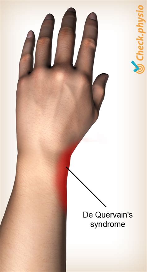 De Quervain S Tendonitis Surgery Recovery