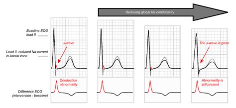 Early Repolarization Vs St Elevation