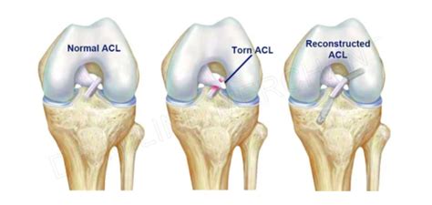 ACL Surgery 7Scope Ortho Care