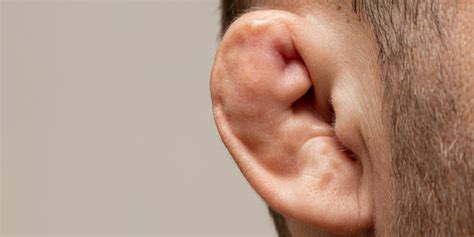 Treatment And Prevention Of Cauliflower Ear Sterosport