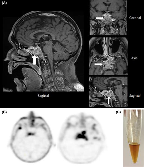 Multiple Myeloma With Clivus Involvement Neurological Symptoms And 45