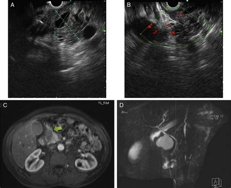 A and B) Endoscopic ultrasound defined a largely hypoechoic lesion ...