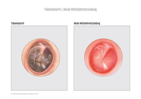 Mittelohrentz Ndung Bei Kindern Und Erwachsenen Hno Praxis Sarnen