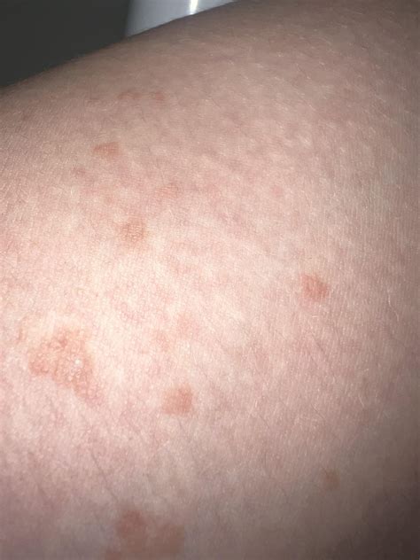 Red Spots On Inner Thigh R Dermatologyquestions