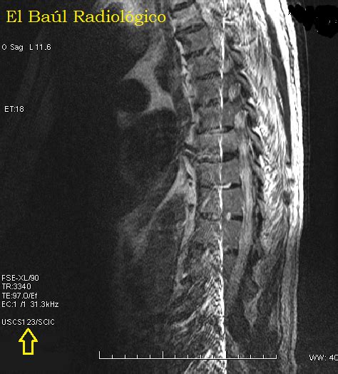 El Baúl Radiológico Artefacto De Anefacto Annefact Artifact In Mri