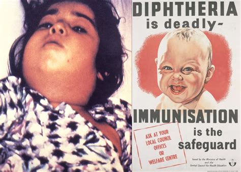 Diphtheria Cases Detected Phaahla Urges Public Not To Panic