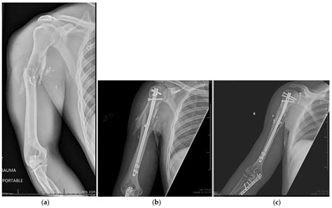 Mechanisms Of Humeral Head Fracture