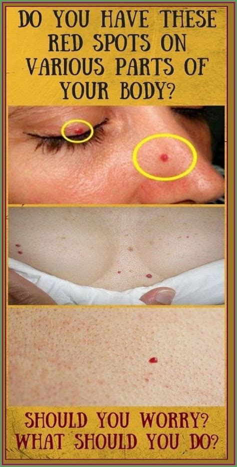 What Causes Red Moles On Skin And How To Get Rid Of Them Artofit