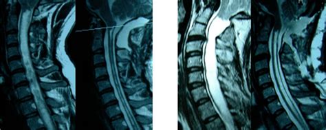 Chiari Malformasyonu Nas L Tedavi Edilir Prof Dr Kenan Ko Beyin