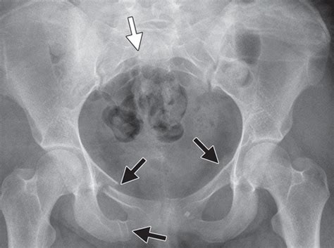 Pelvic Fracture X Ray