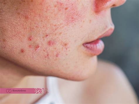 Nodular Acne Treatment Comprehensive Guide Remotederm