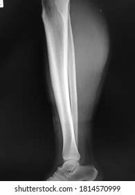 Xray Normal Human Tibia Lateral View Stock Photo 1814570999 Shutterstock