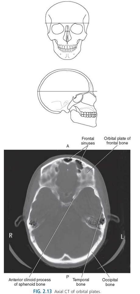 Cranial Bone Anatomy Ct Axial