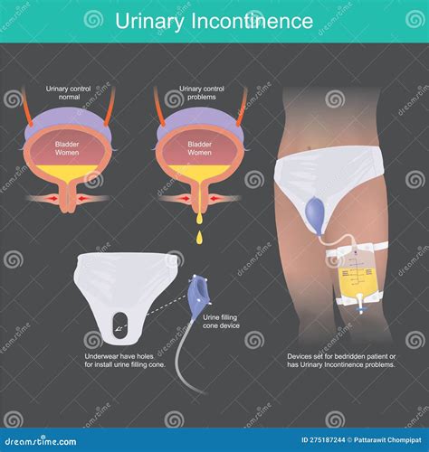 Urinary Incontinence Infographic Cartoon Vector