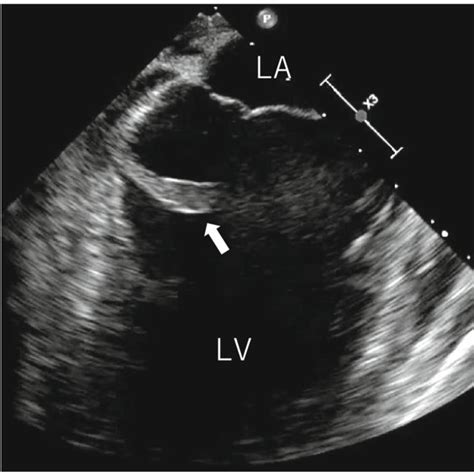 Preoperative Transesophageal Echocardiography Findings Transesophageal Download Scientific