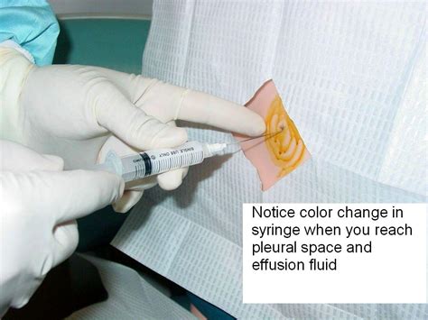 Clinical Notes Thoracentesis A Step By Step Procedure Guide With Photos