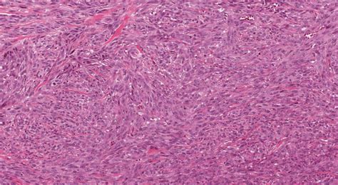 Mucosal Melanoma Of The Oral Cavity Ottawa Atlas Of Pathology