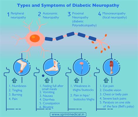 Proximal Neuropathy