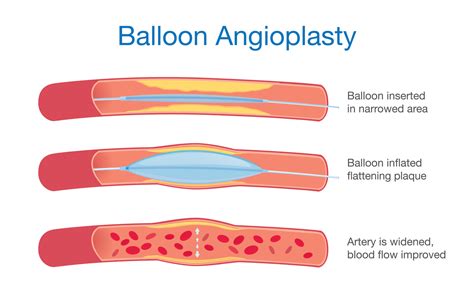 The Angioplasty Debacle Dr Mcdougall