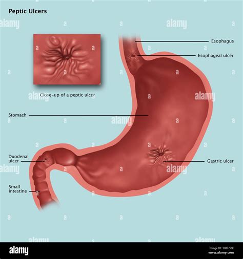 Stomach Ulcers Illustration Stock Photo Alamy