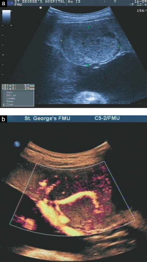 Giant Placental Chorioangioma Natural History And Pregnancy Outcome