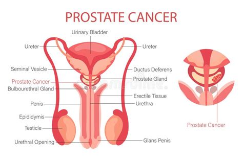 Prostate Cancer. Male Reproductive System. Anatomy of the Internal ...