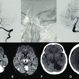 (A) Preoperative left vertebral artery angiography (anterior-posterior ...