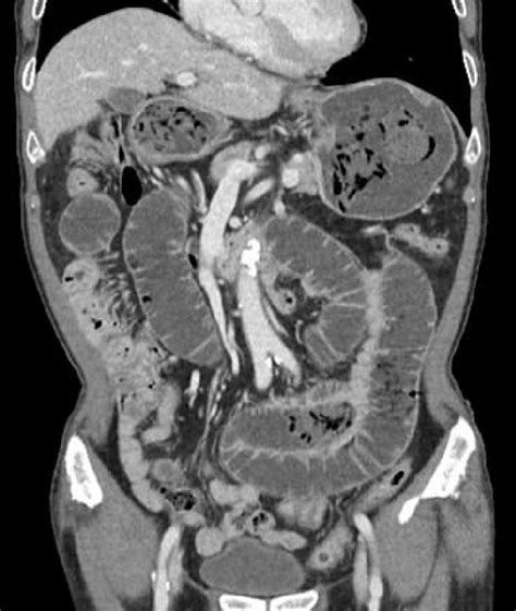 Computed Tomography CT Of The Abdomen And Pelvis Reveal Edematous