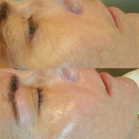 Before And After Of Dermaplaning Before And After Of Dermaplane Laser