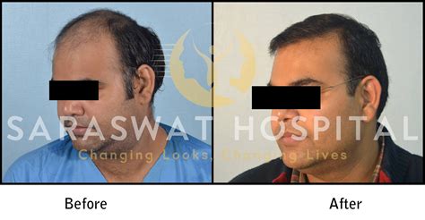 Hair Transplantation Before And After Results Saraswat Hospital