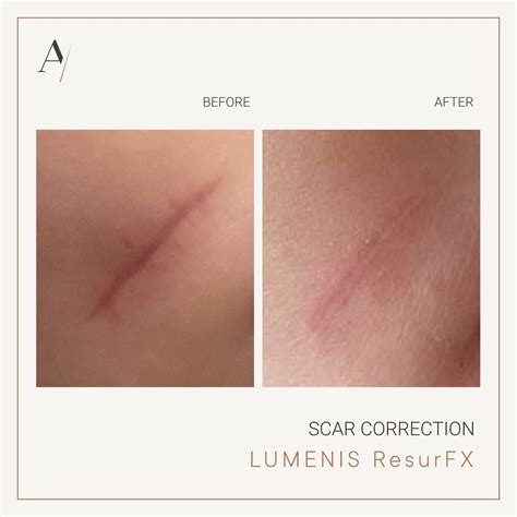 Scar Correction Laserdermatology Azaryan Medical Clinic