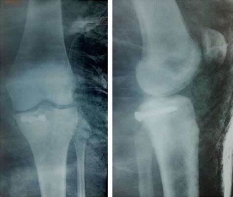 Lateral And Anteroposterior Postoperative Radiographs Of The Left Knee Download Scientific