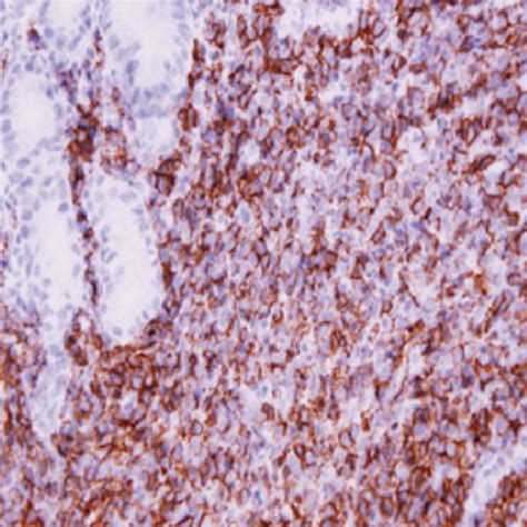 Estudio de inmunohistoquímica para citoqueratina AE1 AE3 identifica la